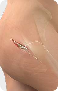Minimally Invasive Total Hip Replacement