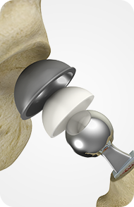 Outpatient Hip Replacement
