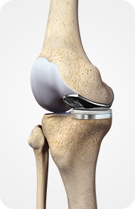 Partial Knee Replacement