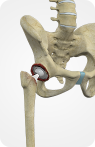 Revision Hip Replacement