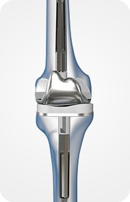 Revision Knee Program
