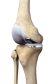 ROSA Robotic Assisted Joint Replacement