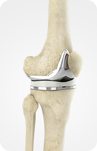 Smart Implant Technology