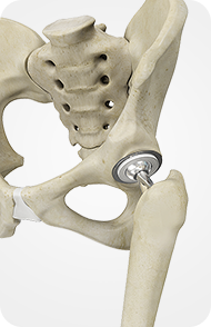 Total Hip Replacement
