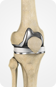 Total Knee Replacement