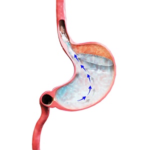 Acid Reflux Pic