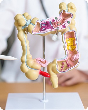 Colorectal Polyps pic