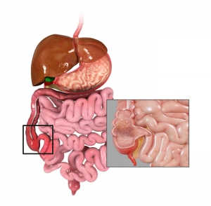 Crohn's Disease Pic