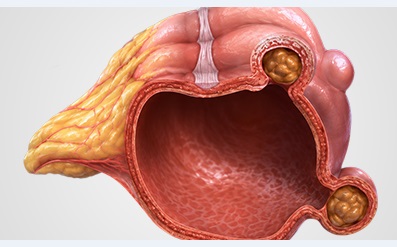 Diverticular Disease Pic