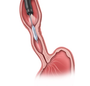 Esophageal Dilation pic