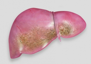 Liver Disease pic