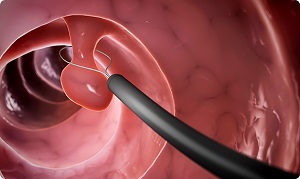 Flexible Sigmoidoscopy  pic