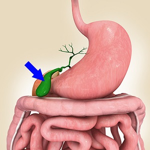 Gallbladder Disease Pic