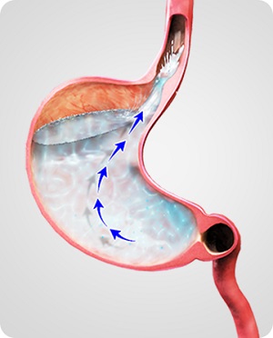 Gastroesophageal Reflux Disease (GERD) pic
