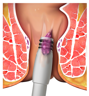 Hemorrhoids pic