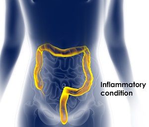 Inflammatory Bowel Disease Pic