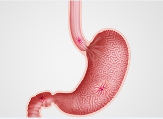 Peptic Ulcer pic