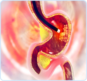 Upper GI Endoscopy pic