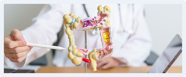 Colon Polyps Img