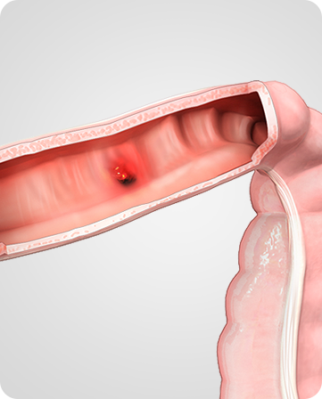 Inflammatory Bowel Img