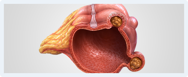 Diverticular Disease Img