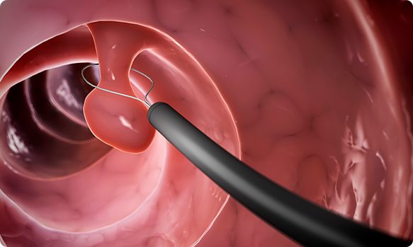 Flexible Sigmoidoscopy Img