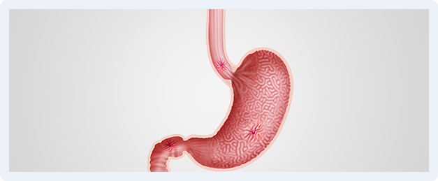 Peptic Ulcer Img