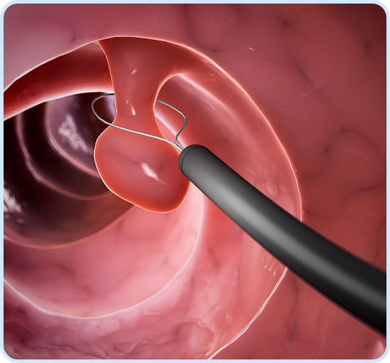 Flexible Sigmoidoscopy Img