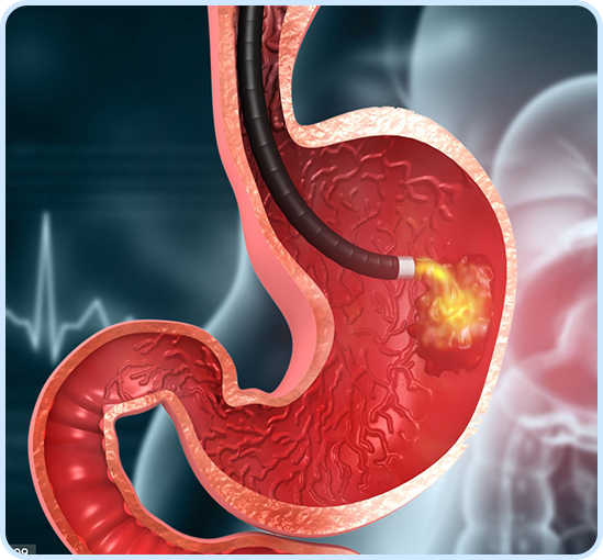 GI Biopsy Img