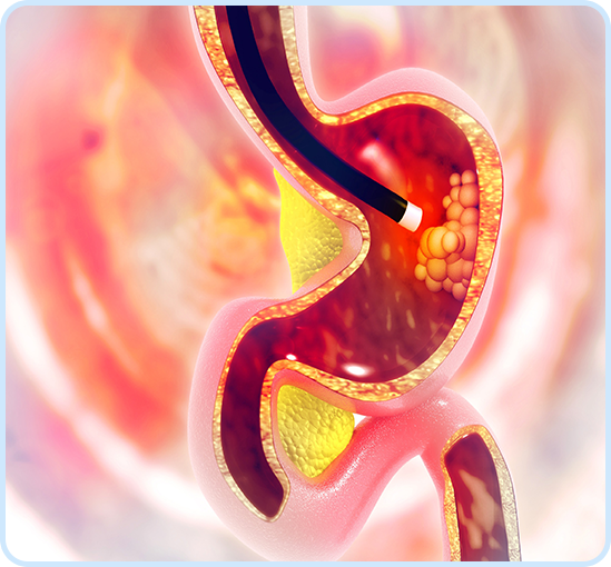 Upper Endoscopy Img