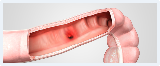 Ulcerative Colitis Img