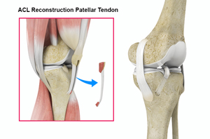 ACL Reconstruction - Educational Picture