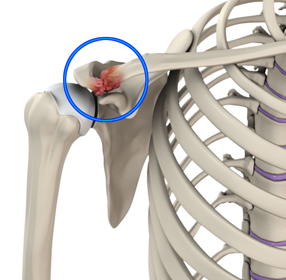 Acromioclavicular (AC) Joint Osteoarthritis - Educational Picture