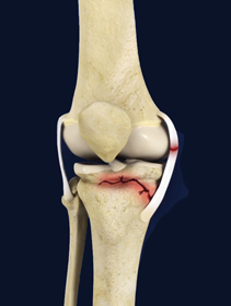 Advanced Athletic Fracture Care - Educational Picture
