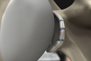 Anterior Shoulder Stabilization - Educational Picture
