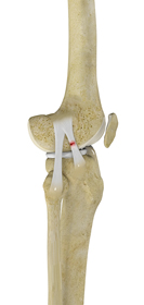 Anterolateral Ligament (ALL) Reconstruction - Educational Picture