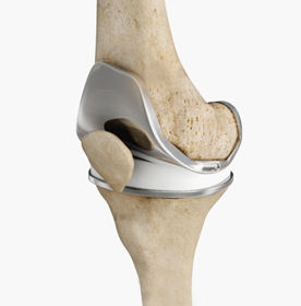 Arthritis Surgery - Educational Picture