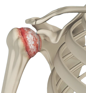 Arthritis - Educational Picture
