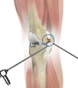 Arthroscopic Reconstruction of the Knee for Ligament Injuries - Educational Picture