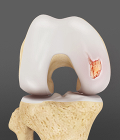 Articular Cartilage Injury - Educational Picture