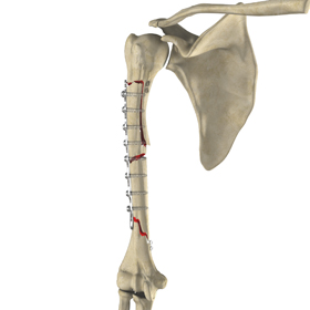 Complex Fracture Repair of the Shoulder - Educational Picture