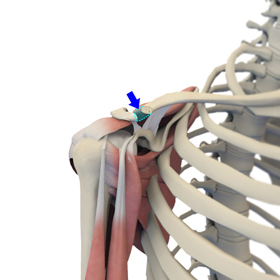Distal Clavicle Excision - Educational Picture