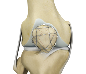 Fracture Care - Educational Picture