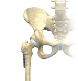 Fracture Surgery - Educational Picture