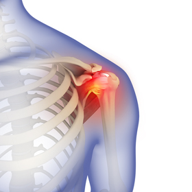 Frozen Shoulder - Educational Picture