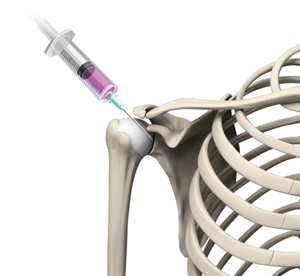 Intraarticular Shoulder Injection - Educational Picture