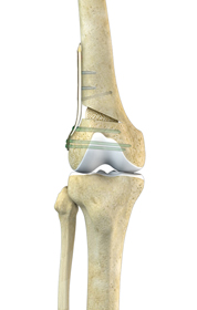 Joint Reconstruction Surgery - Educational Picture