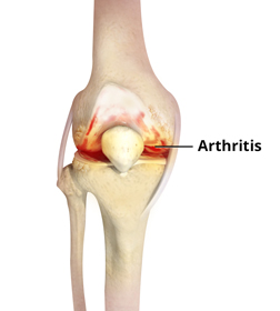 Knee Arthritis - Educational Picture