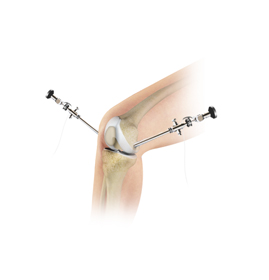 Knee Arthroscopy - Educational Picture