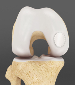 Knee Cartilage Restoration - Educational Picture